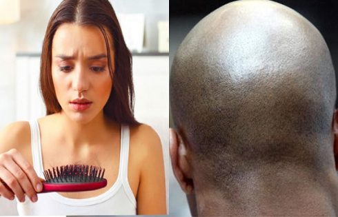 What is Baldness? Main Causes and Possible Treatments